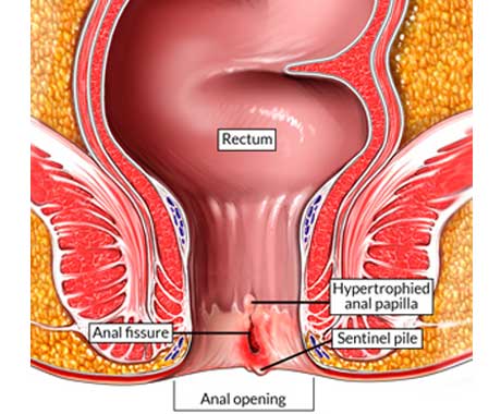 Fissure anal Anal fissure